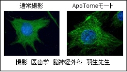通常撮影とApoTomoモード（撮影：医歯学脳神経外科羽生先生）